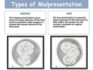 Types of Malpresentation
SINCIPUT
The sinciput presentation occurs
when the larger diameter of the fetal
head is presented. Labor progress is
slowed with slower descent of the
fetal head.
FACE
The face presentation is caused by
hyper-extension of the fetal head so
that neither the occiput nor the
sinciput is palpable on vaginal
examination.
 