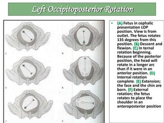Left Occipitoposterior Rotation
• (A) Fetus in cephalic
presentation LOP
position. View is from
outlet. The fetus rotates
135 degrees from this
position. (B) Descent and
flewion. (C) In ternal
rotation beginning.
Because of the posterior
position, the head will
rotate in a longer arc
than if it were in an
anterior position. (D)
Internal rotation
complete. (E) Extension;
the face and the chin are
born. (F) External
rotation; the fetus
rotates to place the
shoulder in an
anteroposterior position
 
