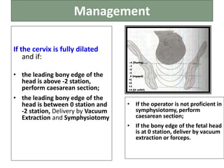 Management
If the cervix is fully dilated
and if:
• the leading bony edge of the
head is above -2 station,
perform caesarean section;
• the leading bony edge of the
head is between 0 station and
-2 station, Delivery by Vacuum
Extraction and Symphysiotomy
• If the operator is not proficient in
symphysiotomy, perform
caesarean section;
• If the bony edge of the fetal head
is at 0 station, deliver by vacuum
extraction or forceps.
 