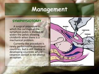 Management
SYMPHYSIOTOMY
A surgical procedure in
which the cartilage of the
symphysis pubis is divided to
widen the pelvis allowing
childbirth when there is a
mechanical problem.
Currently the procedure is
rarely performed in developed
countries, but is still routine in
developing countries where
cesarean section is not always
an option.
 