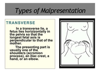 malpresentations