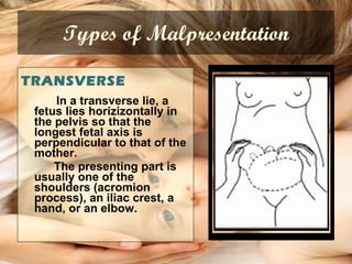 Types of Malpresentation TRANSVERSE In a transverse lie, a fetus lies horizizontally in the pelvis so that the longest fetal axis is perpendicular to that of the mother.  The presenting part is usually one of the shoulders (acromion process), an iliac crest, a hand, or an elbow. 