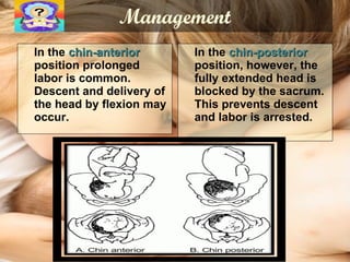 Management In the  chin-anterior   position prolonged labor is common. Descent and delivery of the head by flexion may occur. In the  chin-posterior  position, however, the fully extended head is blocked by the sacrum. This prevents descent and labor is arrested.  