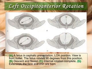 Left Occipitoanterior Rotation (A)  A fetus in cephalic presentation, LOA position. View is from outlet. The fetus rotates 90 degrees from this position.  (B)  Descent and flexion  (C)  Internal rotation complete . (D)  Extension; the face and chin are born 