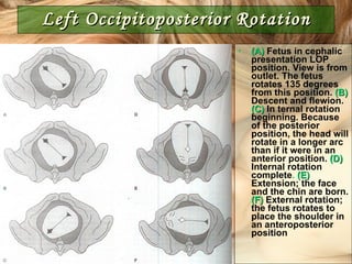 Left Occipitoposterior Rotation (A)   Fetus in cephalic presentation LOP position. View is from outlet. The fetus rotates 135 degrees from this position.   (B)   Descent and flewion.   (C)   In ternal rotation beginning. Because of the posterior position, the head will rotate in a longer arc than if it were in an anterior position.   (D)   Internal rotation complete .  (E)   Extension; the face and the chin are born.   (F)   External rotation; the fetus rotates to place the shoulder in an anteroposterior position 