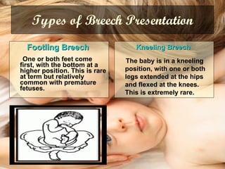 Types of Breech Presentation Footling Breech   One or both feet come first, with the bottom at a higher position. This is rare at term but relatively common with premature fetuses.   Kneeling Breech   The baby is in a kneeling position, with one or both legs extended at the hips and flexed at the knees. This is extremely rare.  