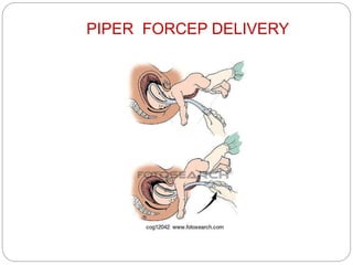 PIPER FORCEP DELIVERY
 