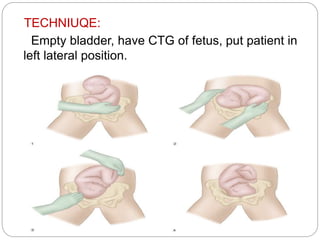 TECHNIUQE:
Empty bladder, have CTG of fetus, put patient in
left lateral position.
 