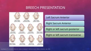 Malpresentation - Breech delivery.1705.pptx