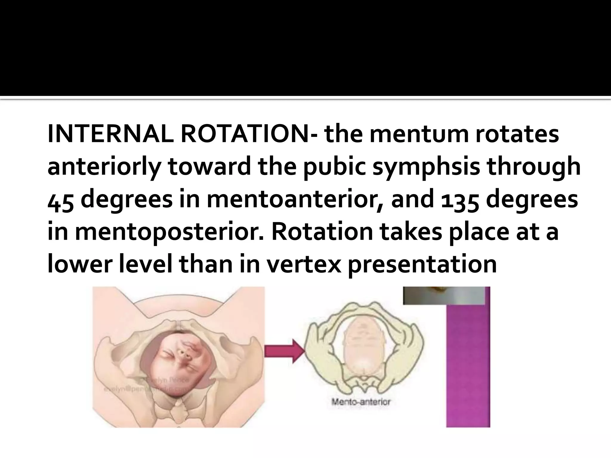 INTERNAL ROTATION- the mentum rotates
anteriorly toward the pubic symphsis through
45 degrees in mentoanterior, and 135 degrees
in mentoposterior. Rotation takes place at a
lower level than in vertex presentation
 