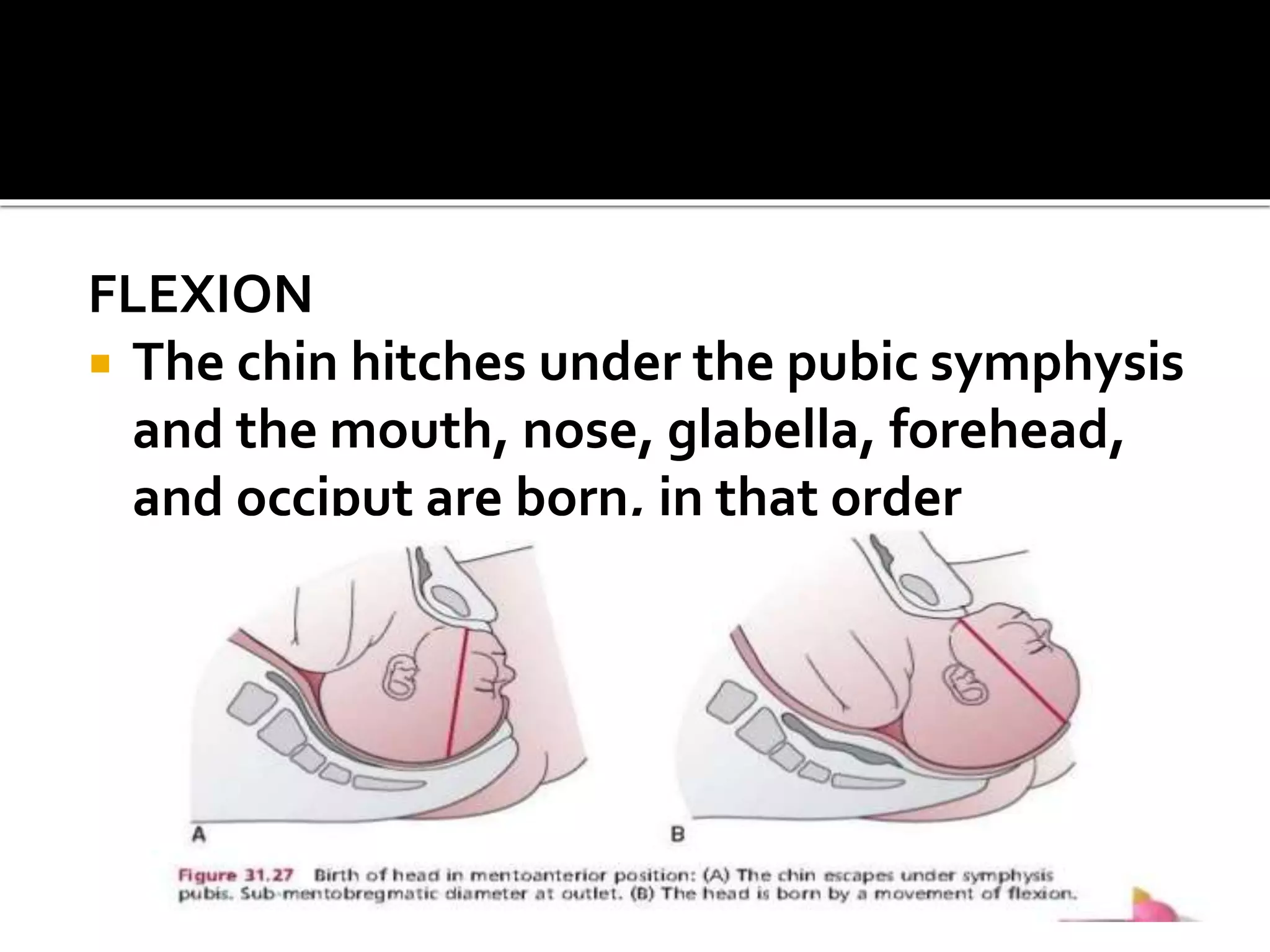 FLEXION
 The chin hitches under the pubic symphysis
and the mouth, nose, glabella, forehead,
and occiput are born, in that order
 