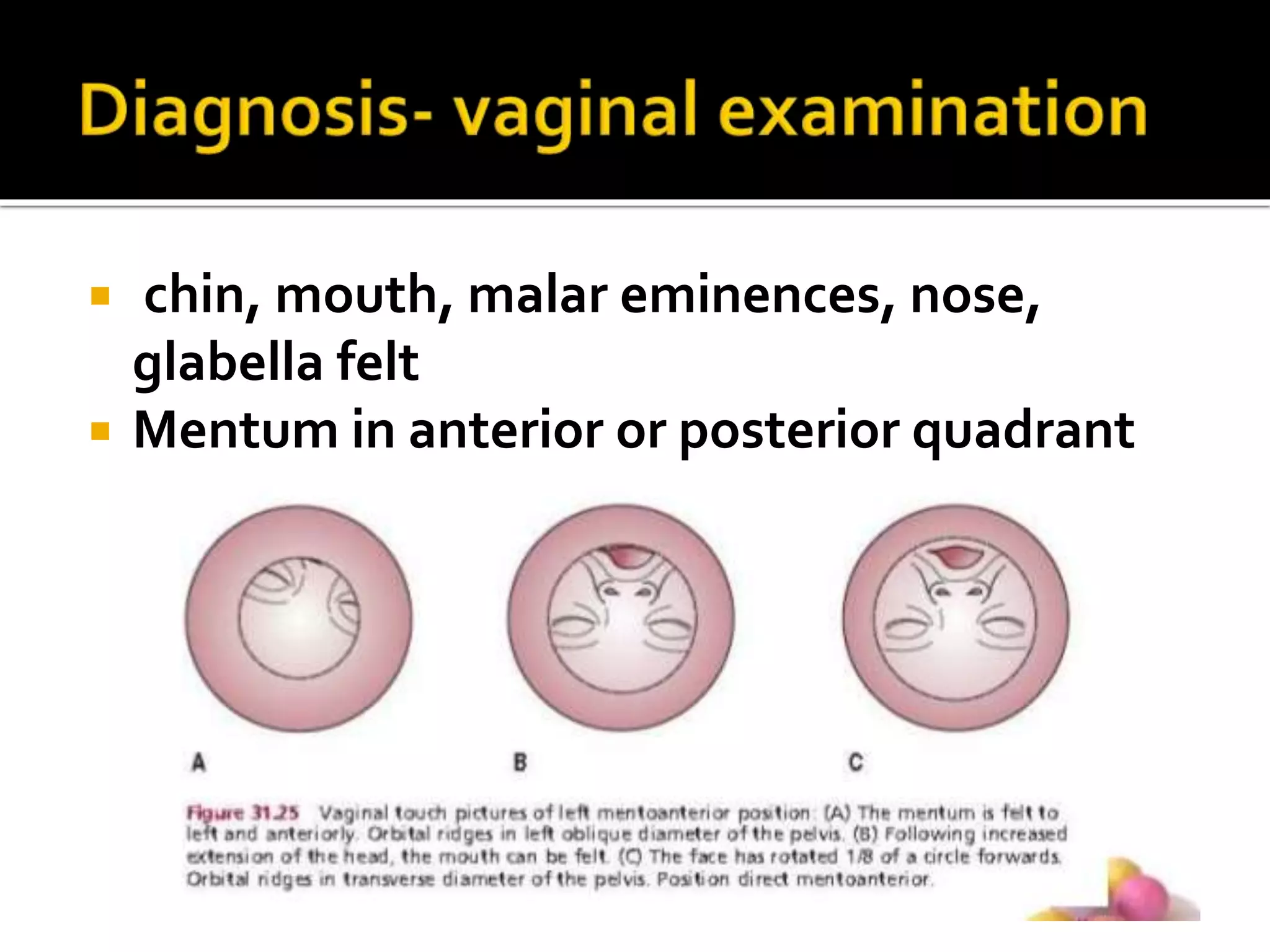  chin, mouth, malar eminences, nose,
glabella felt
 Mentum in anterior or posterior quadrant
 