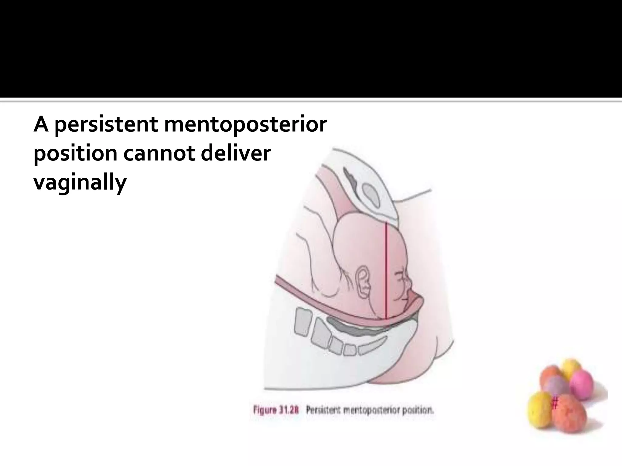 A persistent mentoposterior
position cannot deliver
vaginally
 