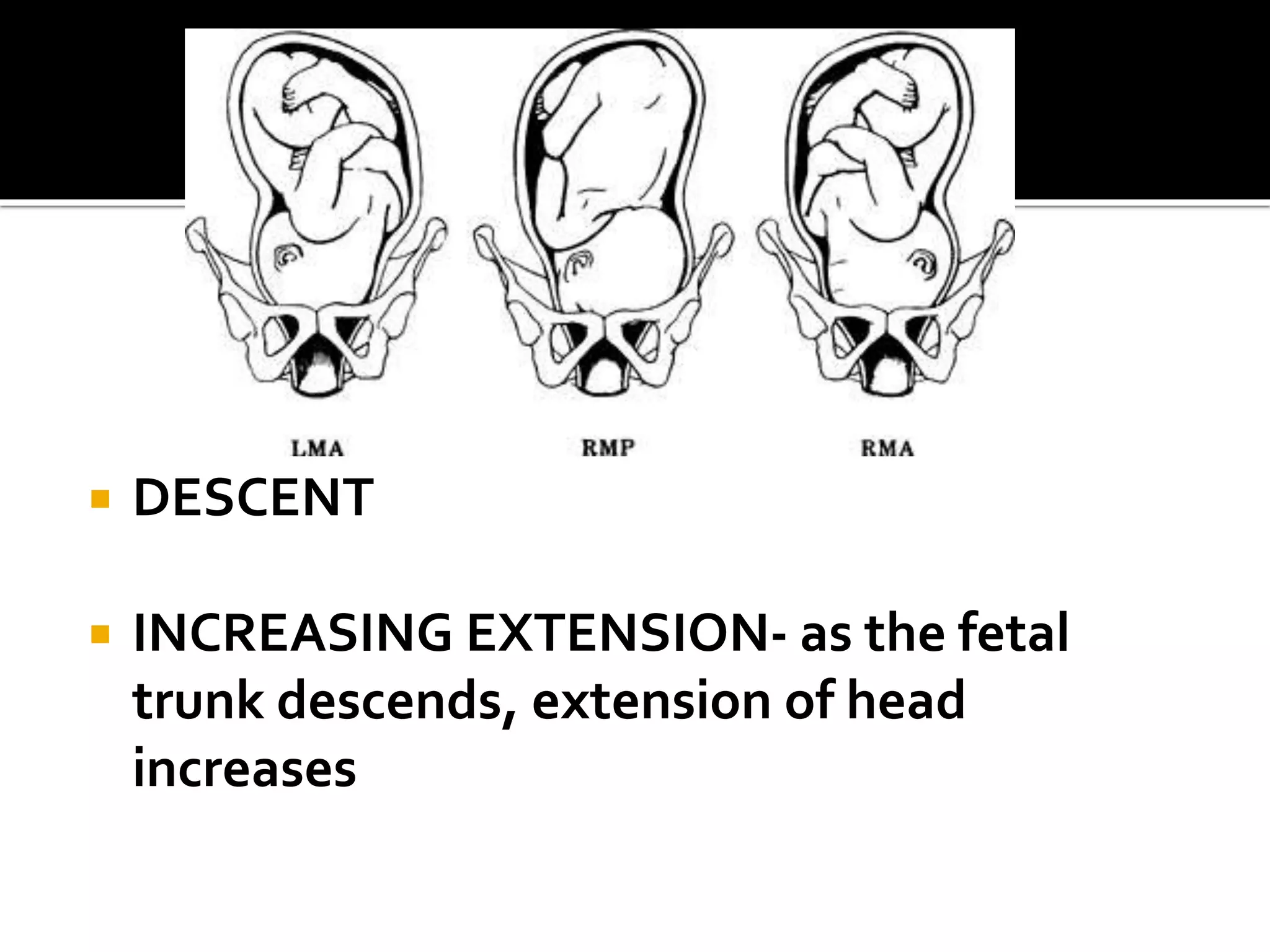  DESCENT
 INCREASING EXTENSION- as the fetal
trunk descends, extension of head
increases
 