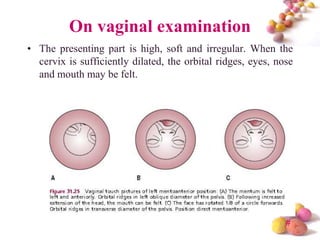 On vaginal examination
• The presenting part is high, soft and irregular. When the
cervix is sufficiently dilated, the orbital ridges, eyes, nose
and mouth may be felt.

#

 