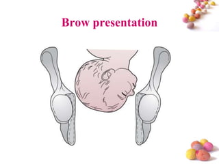 Brow presentation

#

 