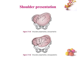 Shoulder presentation

#

 