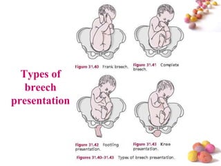 Types of
breech
presentation

#

 