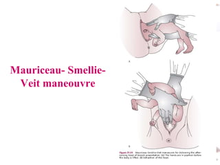 Mauriceau- SmellieVeit maneouvre

#

 