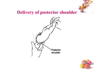 Delivery of posterior shoulder

#

 