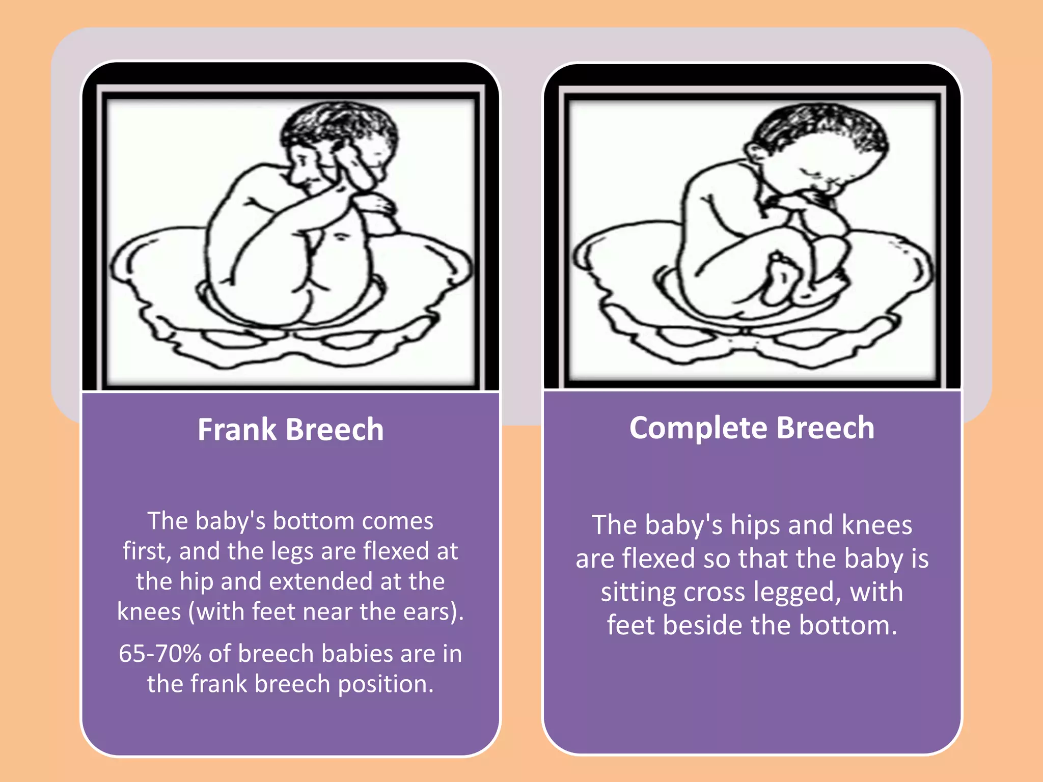 Frank Breech                     Complete Breech

   The baby's bottom comes           The baby's hips and knees
first, and the legs are flexed at   are flexed so that the baby is
  the hip and extended at the         sitting cross legged, with
knees (with feet near the ears).
                                       feet beside the bottom.
65-70% of breech babies are in
  the frank breech position.
 