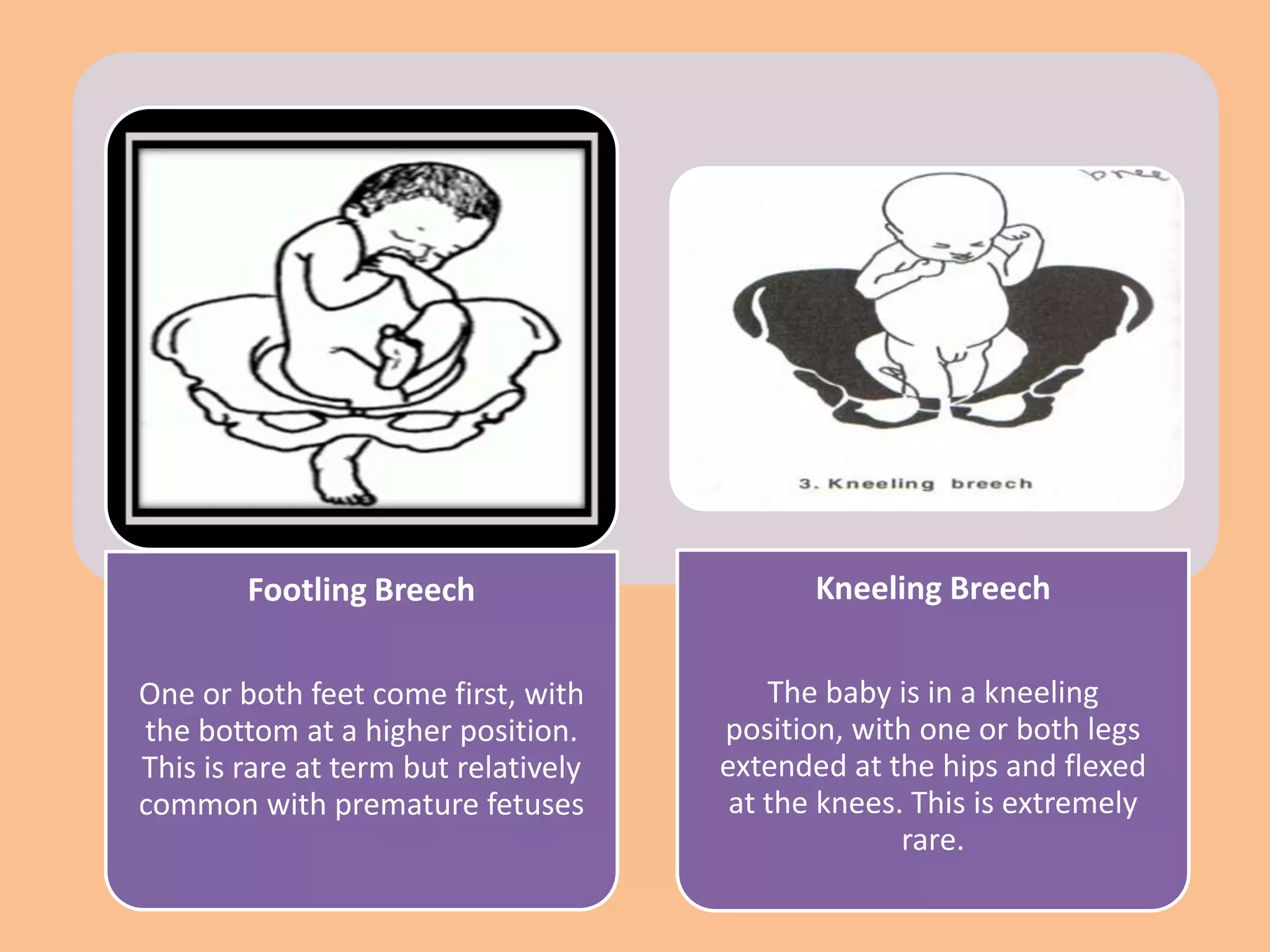 Footling Breech                      Kneeling Breech

One or both feet come first, with         The baby is in a kneeling
the bottom at a higher position.      position, with one or both legs
This is rare at term but relatively   extended at the hips and flexed
common with premature fetuses          at the knees. This is extremely
                                                    rare.
 