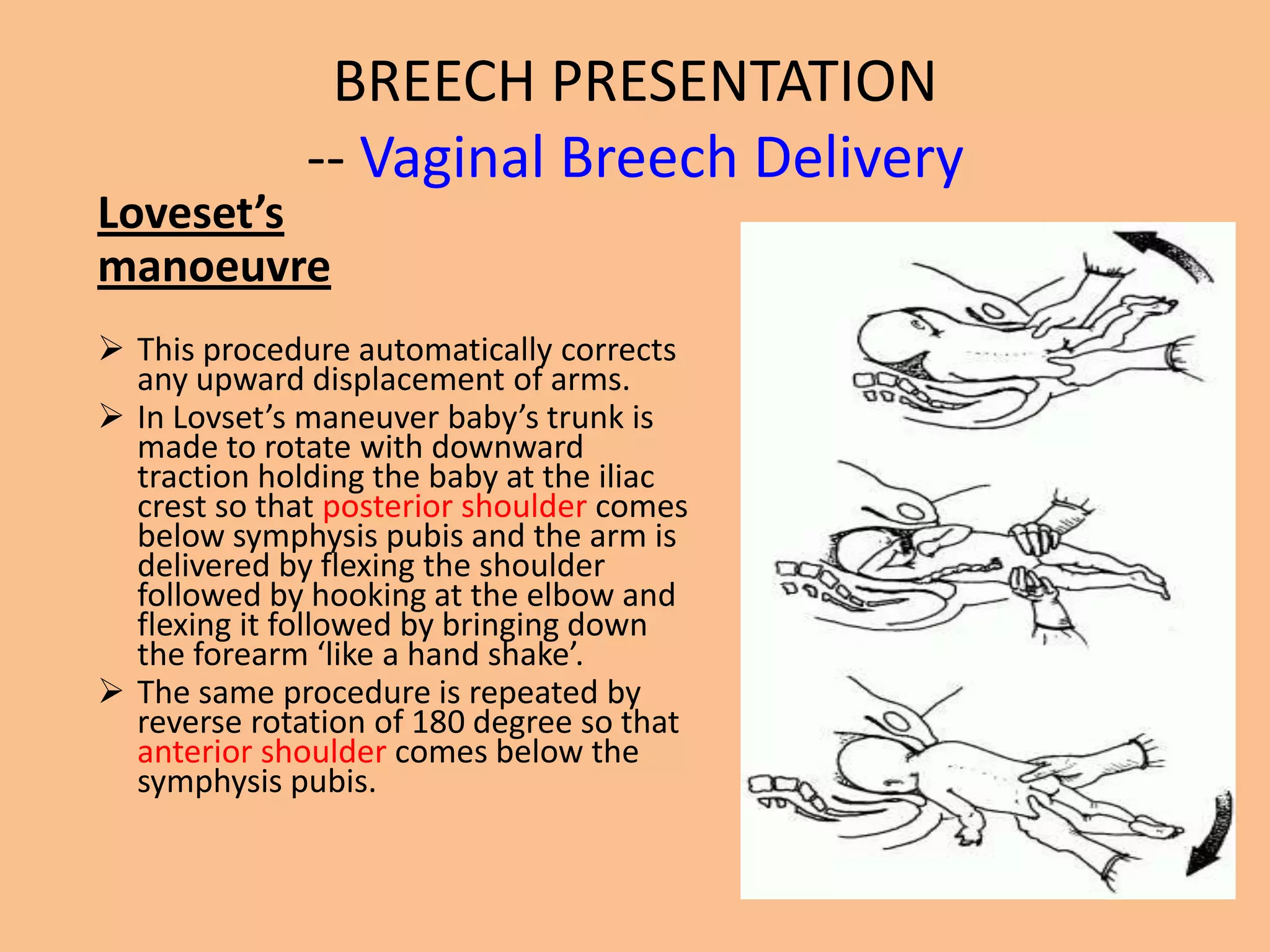 BREECH PRESENTATION
              -- Vaginal Breech Delivery
Loveset’s
manoeuvre
 This procedure automatically corrects
  any upward displacement of arms.
 In Lovset’s maneuver baby’s trunk is
  made to rotate with downward
  traction holding the baby at the iliac
  crest so that posterior shoulder comes
  below symphysis pubis and the arm is
  delivered by flexing the shoulder
  followed by hooking at the elbow and
  flexing it followed by bringing down
  the forearm ‘like a hand shake’.
 The same procedure is repeated by
  reverse rotation of 180 degree so that
  anterior shoulder comes below the
  symphysis pubis.
 