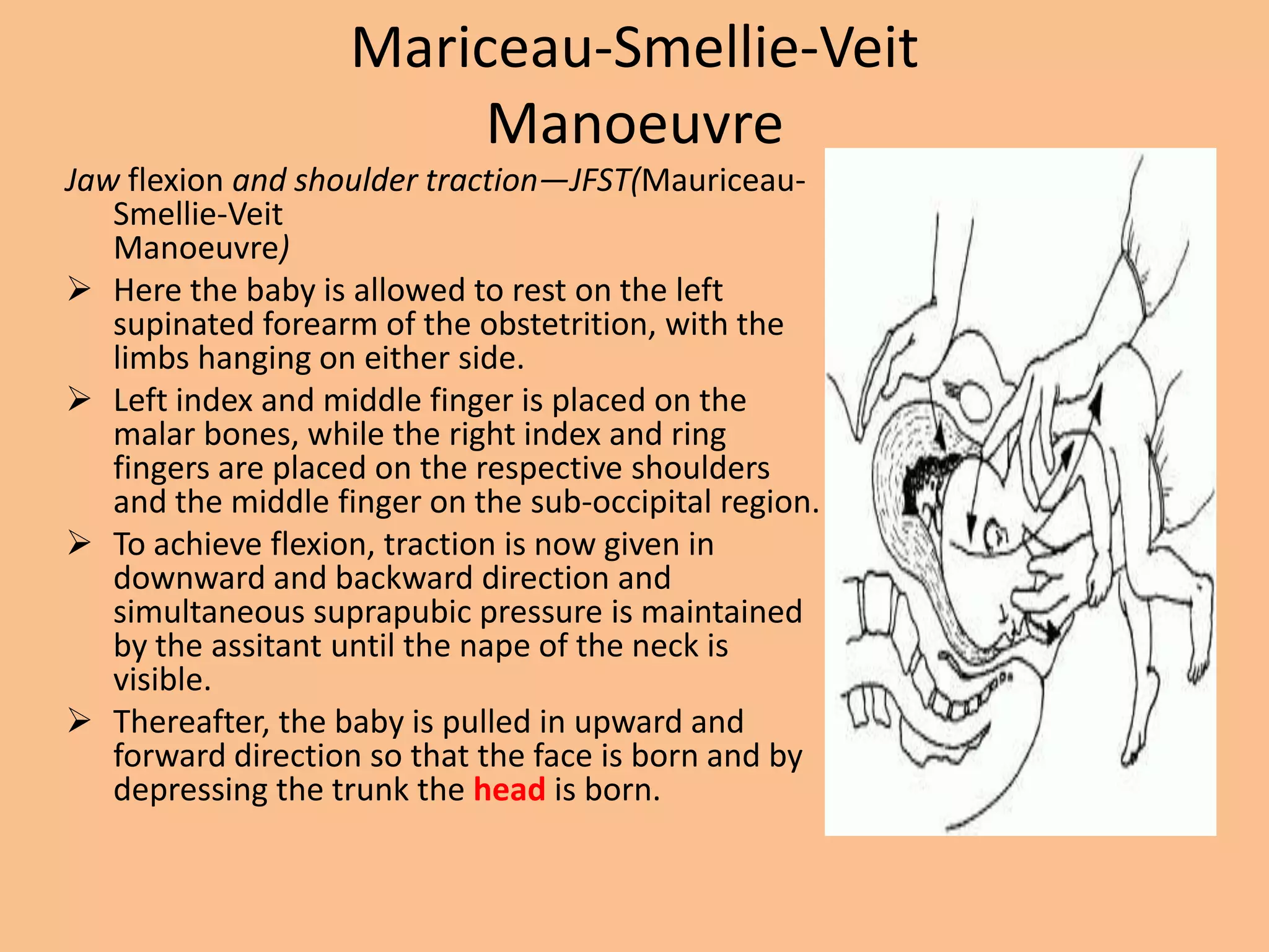 Mariceau-Smellie-Veit
                        Manoeuvre
Jaw flexion and shoulder traction—JFST(Mauriceau-
   Smellie-Veit
   Manoeuvre)
 Here the baby is allowed to rest on the left
   supinated forearm of the obstetrition, with the
   limbs hanging on either side.
 Left index and middle finger is placed on the
   malar bones, while the right index and ring
   fingers are placed on the respective shoulders
   and the middle finger on the sub-occipital region.
 To achieve flexion, traction is now given in
   downward and backward direction and
   simultaneous suprapubic pressure is maintained
   by the assitant until the nape of the neck is
   visible.
 Thereafter, the baby is pulled in upward and
   forward direction so that the face is born and by
   depressing the trunk the head is born.
 
