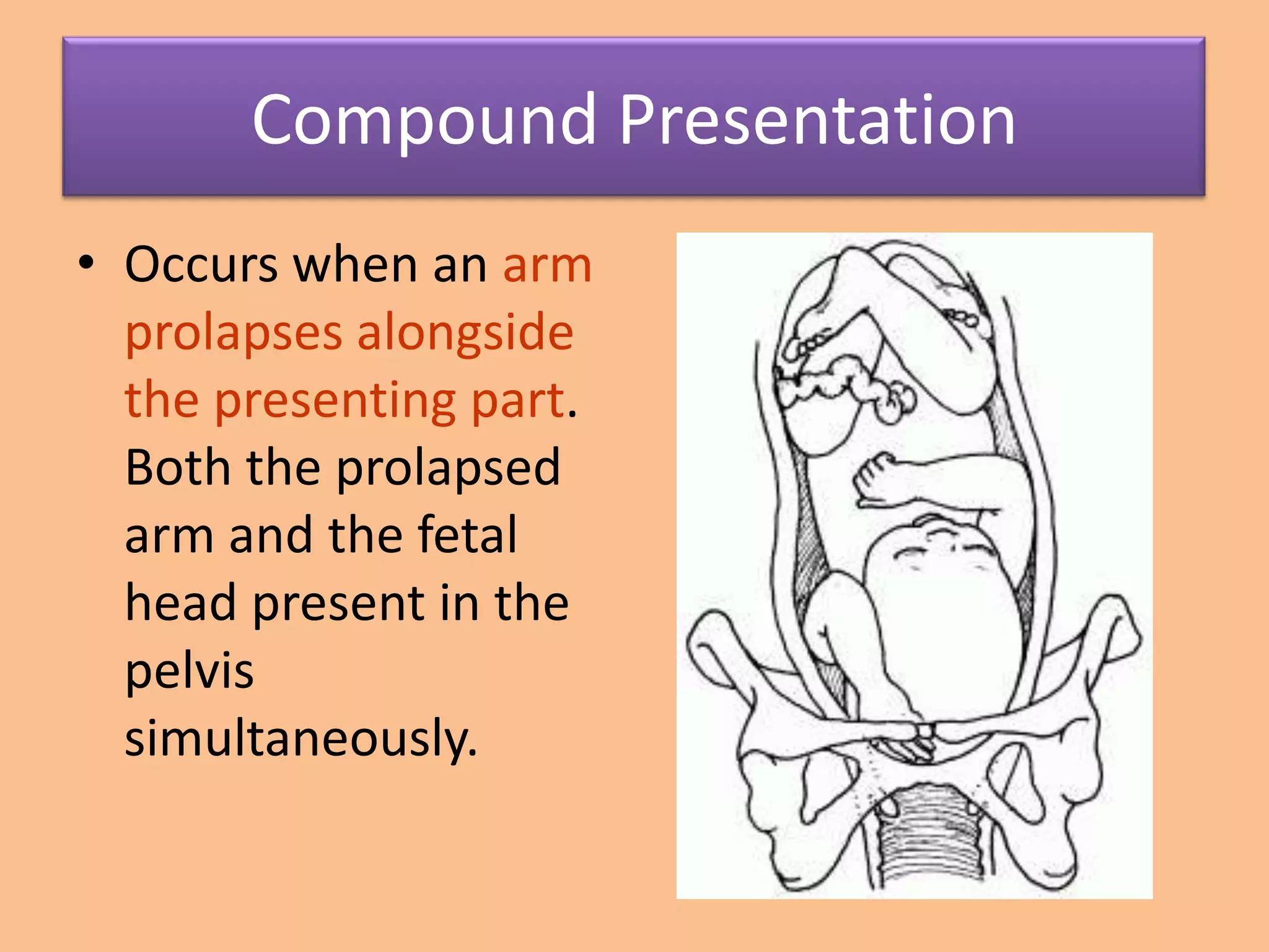 Compound Presentation
• Occurs when an arm
  prolapses alongside
  the presenting part.
  Both the prolapsed
  arm and the fetal
  head present in the
  pelvis
  simultaneously.
 