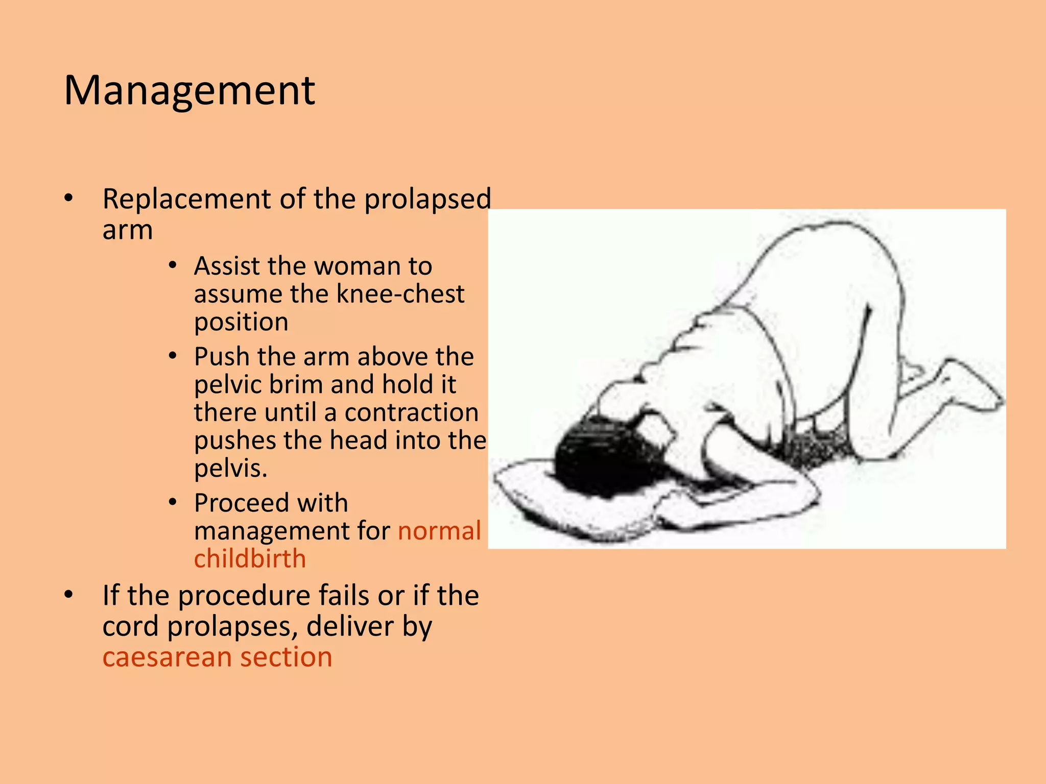 Management

• Replacement of the prolapsed
  arm
        • Assist the woman to
          assume the knee-chest
          position
        • Push the arm above the
          pelvic brim and hold it
          there until a contraction
          pushes the head into the
          pelvis.
        • Proceed with
          management for normal
          childbirth
• If the procedure fails or if the
  cord prolapses, deliver by
  caesarean section
 