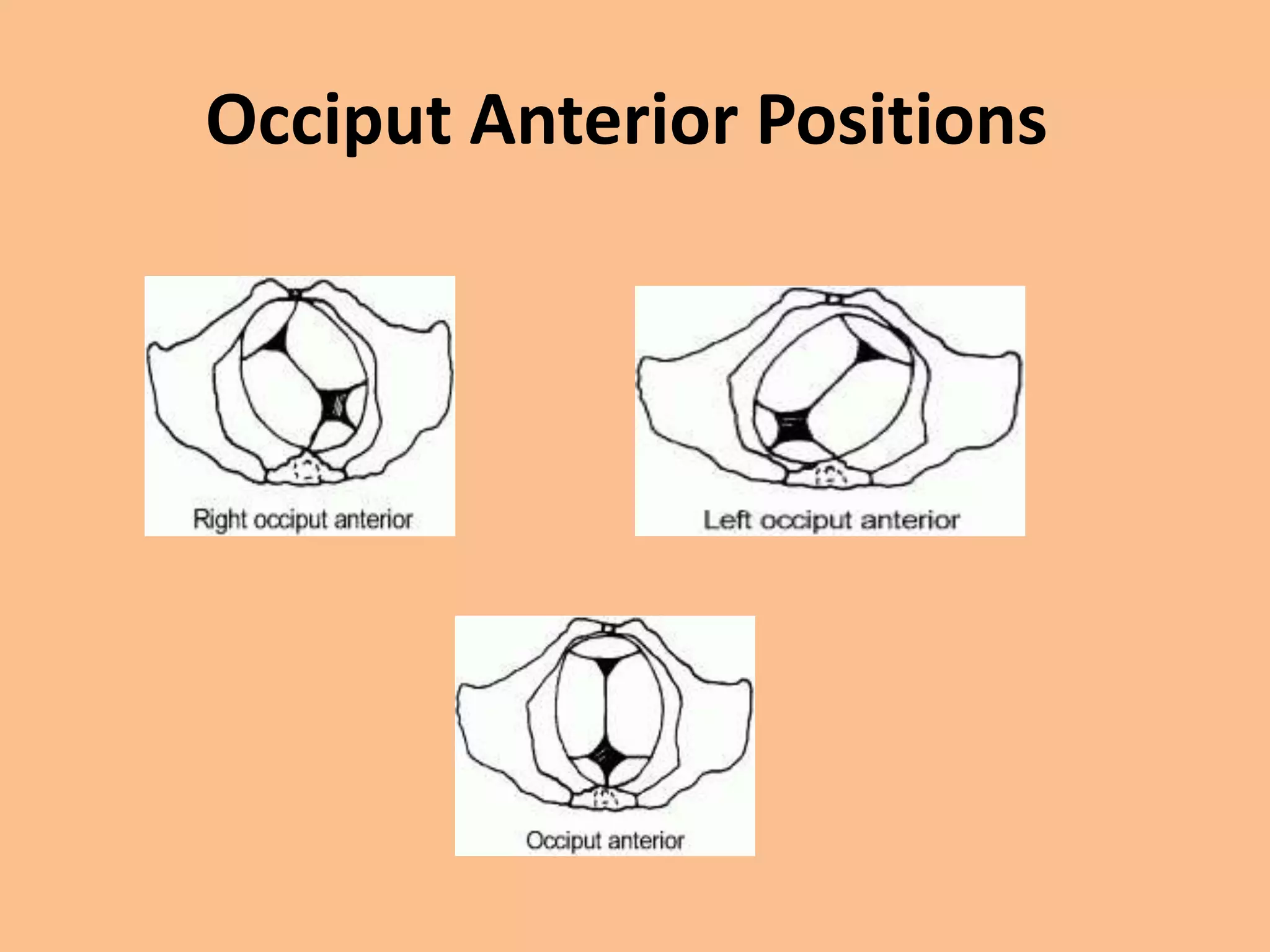 Occiput Anterior Positions
 