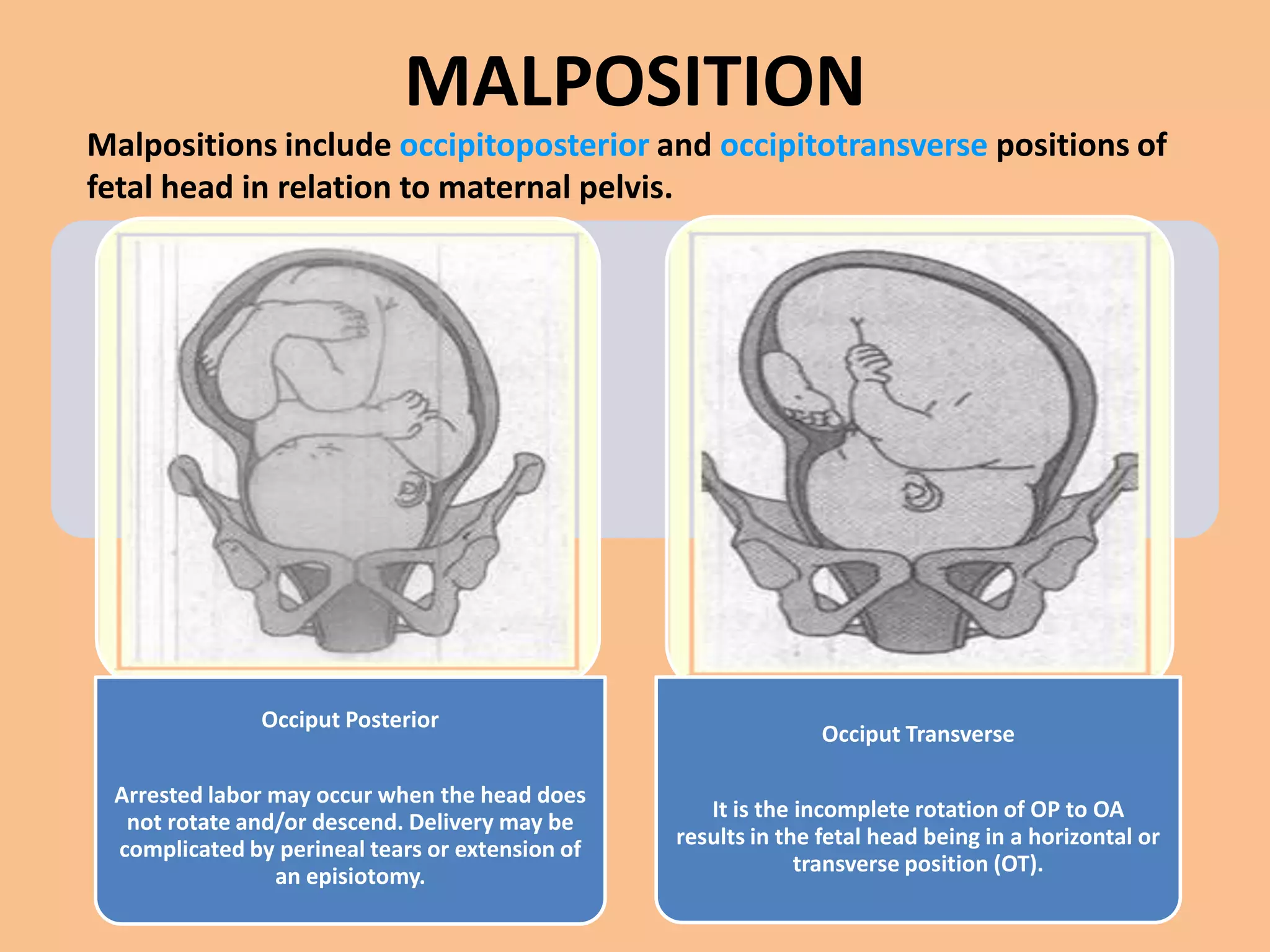 MALPOSITION
Malpositions include occipitoposterior and occipitotransverse positions of
fetal head in relation to maternal pelvis.




               Occiput Posterior
                                                                Occiput Transverse

 Arrested labor may occur when the head does
                                                    It is the incomplete rotation of OP to OA
  not rotate and/or descend. Delivery may be
                                                 results in the fetal head being in a horizontal or
 complicated by perineal tears or extension of
                                                              transverse position (OT).
                an episiotomy.
 