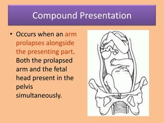 Compound Presentation
• Occurs when an arm
  prolapses alongside
  the presenting part.
  Both the prolapsed
  arm and the fetal
  head present in the
  pelvis
  simultaneously.
 