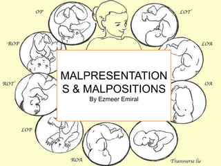MALPRESENTATION
S & MALPOSITIONS
    By Ezmeer Emiral
 