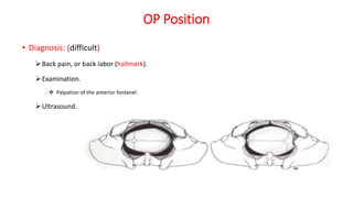 OP Position
• Diagnosis: (difficult)
Back pain, or back labor (hallmark).
Examination.
 Palpation of the anterior fontanel.
Ultrasound.
 