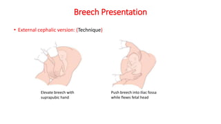 Breech Presentation
• External cephalic version: (Technique)
Elevate breech with
suprapubic hand
Push breech into iliac fossa
while flexes fetal head
 