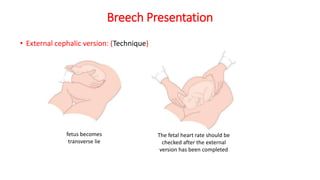 Breech Presentation
• External cephalic version: (Technique)
fetus becomes
transverse lie
The fetal heart rate should be
checked after the external
version has been completed
 