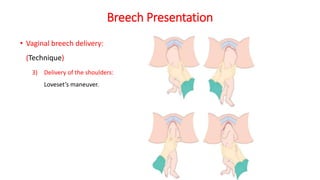 Breech Presentation
• Vaginal breech delivery:
(Technique)
3) Delivery of the shoulders:
Loveset’s maneuver.
 