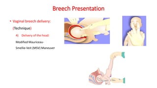 Breech Presentation
• Vaginal breech delivery:
(Technique)
4) Delivery of the head:
Modified Mauriceau‐
Smellie‐Veit (MSV) Maneuver
 