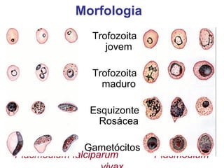 Plasmodium falciparum Plasmodium
Trofozoita
jovem
Trofozoita
maduro
Esquizonte
Rosácea
Gametócitos
Morfologia
 