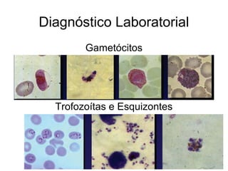 Diagnóstico Laboratorial
Gametócitos
Trofozoítas e Esquizontes
 