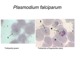 Plasmodium falciparum
Trofozoíto jovem Trofozoíto e Esquizonte (raro)
 