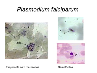 Plasmodium falciparum
Esquizonte com merozoítos Gametócitos
 