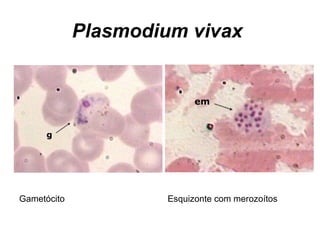 Plasmodium vivax
Gametócito Esquizonte com merozoítos
 