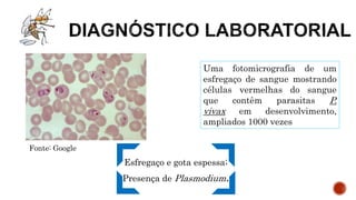 Esfregaço e gota espessa;
Presença de Plasmodium.
Fonte: Google
Uma fotomicrografia de um
esfregaço de sangue mostrando
células vermelhas do sangue
que contêm parasitas P.
vivax em desenvolvimento,
ampliados 1000 vezes
 