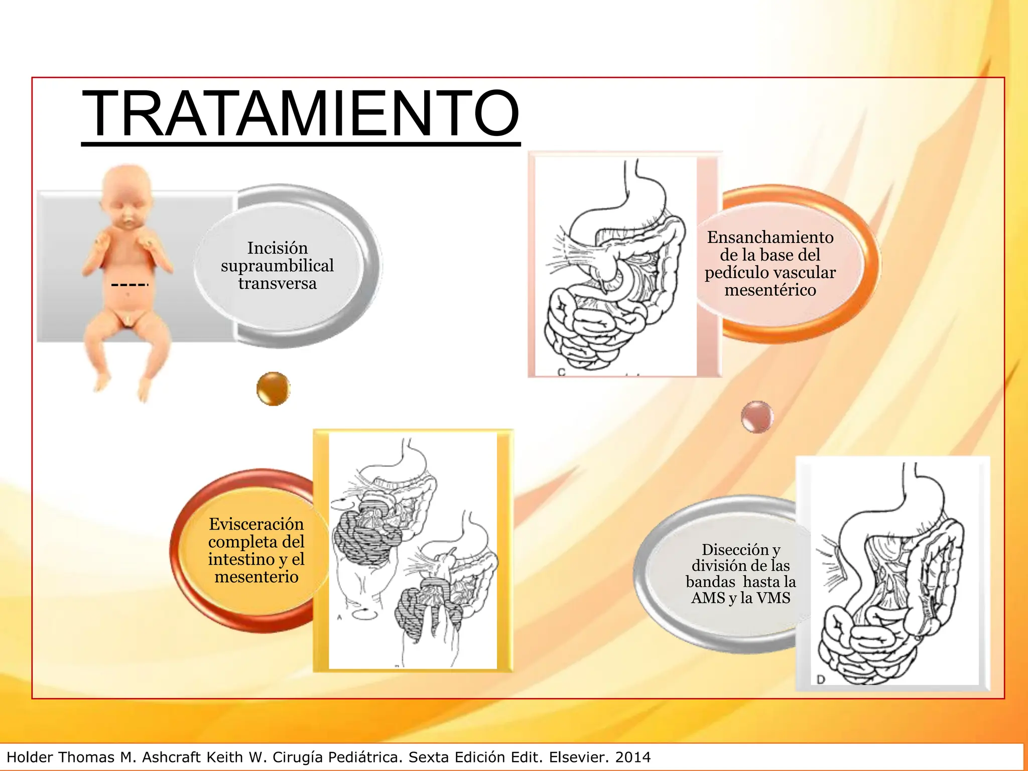 malrotaci-n-intestinal-cirugia-pediatricapptx-ppt