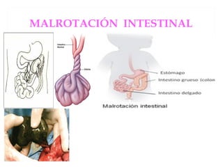 MALROTACIÓN INTESTINAL
 