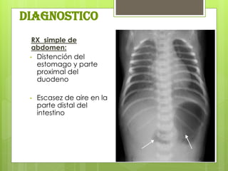 DIaGNOSTICO 
RX simple de abdomen: 
•Distención del estomago y parte proximal del duodeno 
•Escasez de aire en la parte distal del intestino  