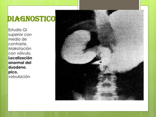 Estudio GI superior con medio de contraste. Malrotación con vólvulo, Localización anormal del duodeno, pico, volvulación 
diagnostico  