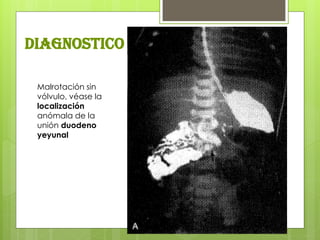 Malrotación sin vólvulo, véase la localización anómala de la unión duodeno yeyunal 
diagnostico  